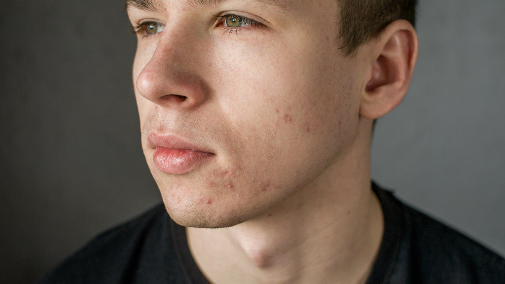 TOP 5 SKIN CONDITIONS THAT CAN MASSIVELY AFFECT YOUR CONFIDENCE AS A MAN